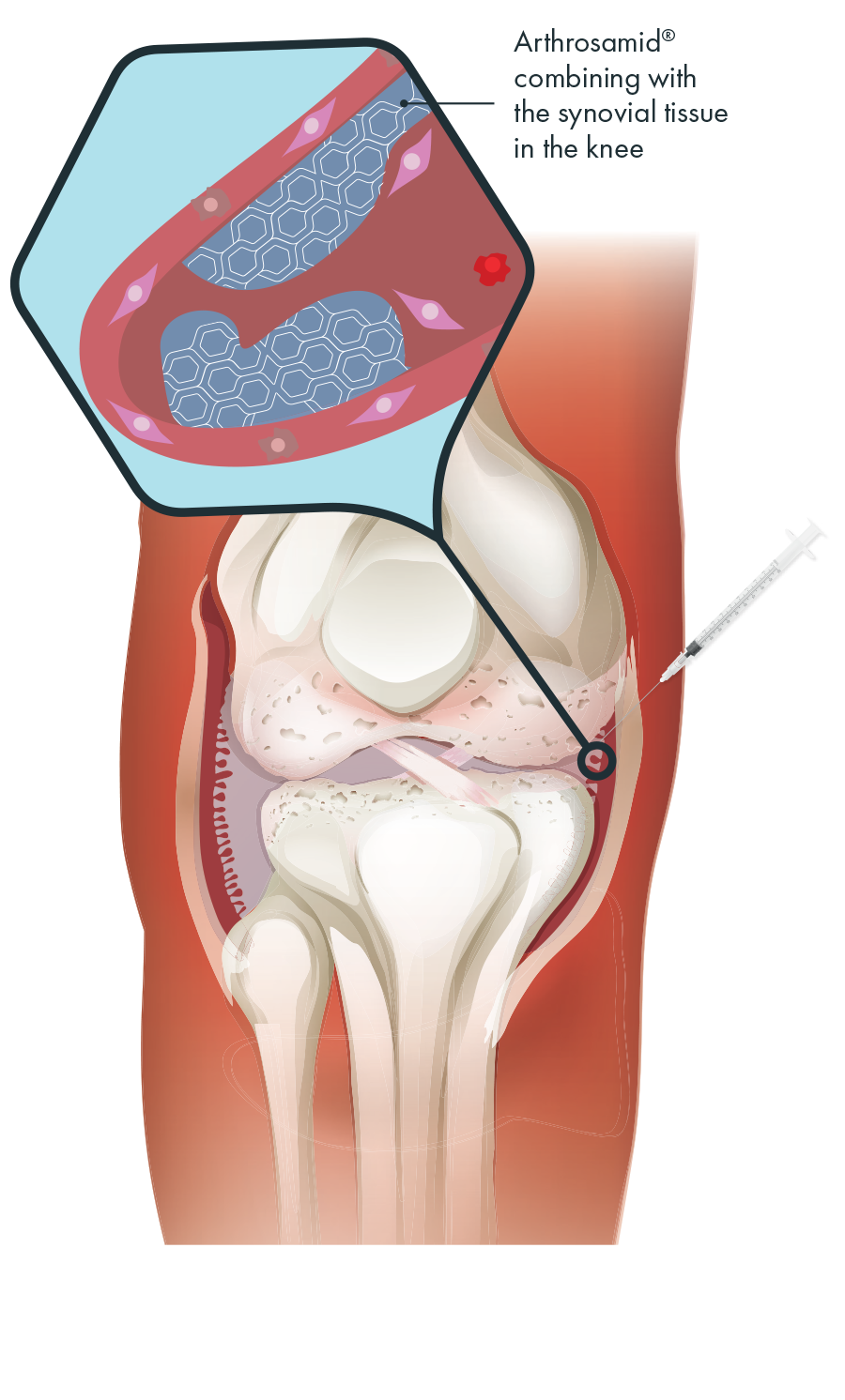 Arthrosamid® knee osteoarthritis treatment at Phoenix Medical Clinic in Watford